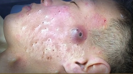 Blackheads Pimple Popper on Face 97