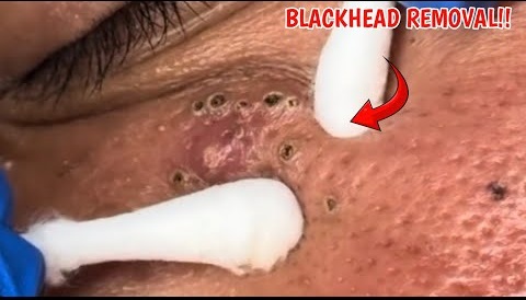 Blackheads Pimple Popper on Face 100