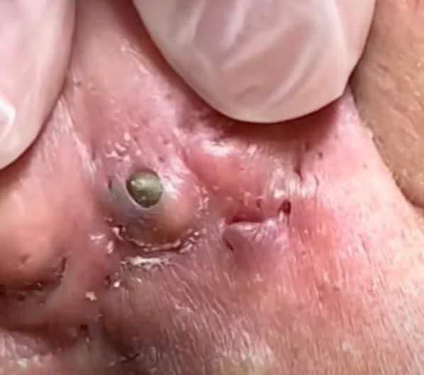 Blackheads, also known as open comedones