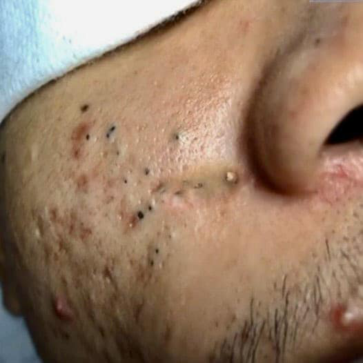 Blackheads Pimple Popper on Face 2