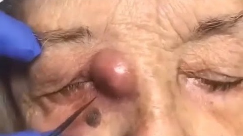 Blackheads Pimple Popper on Face 83