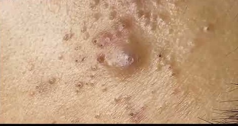 Blackheads Pimple Popper on Face 99