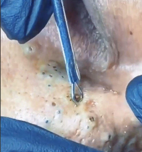 Blackheads Pimple Popper on Face 13