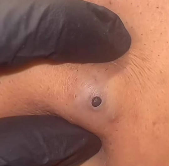 Blackheads Pimple Popper on Face 7