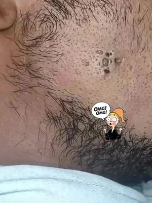 Blackheads Pimple Popper on Face 9