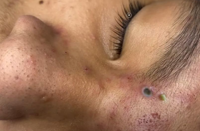 Blackheads Pimple Popper on Face 86