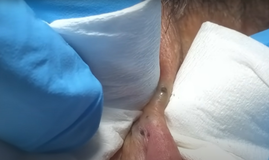 Blackheads Pimple Popper on Face 58