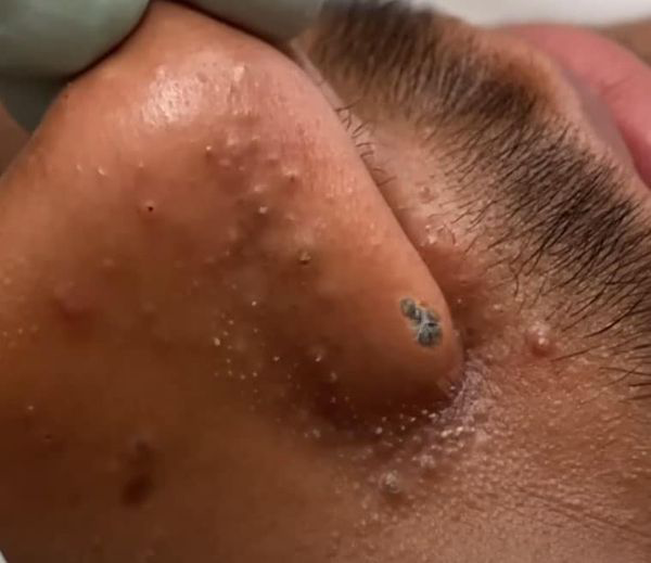 Blackheads Pimple Popper on Face 14