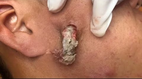 Blackheads Pimple Popper on Face 104