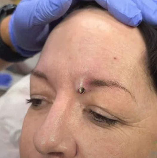 Blackheads Pimple Popper on Face 31