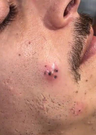 Blackheads Pimple Popper on Face 95