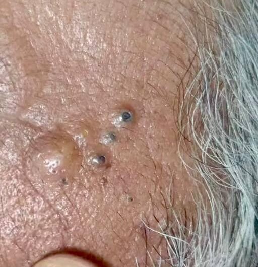 Blackheads Pimple Popper on Face 110