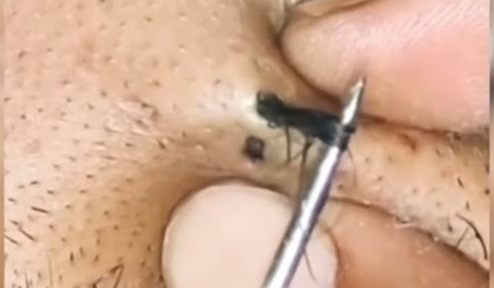 Blackheads Pimple Popper on Face 98