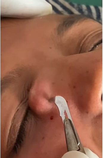 Blackheads Pimple Popper on Face 133