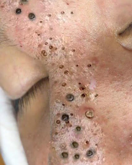 Blackheads Pimple Popper on Face 246