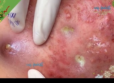 Blackheads Pimple Popper on Face 118