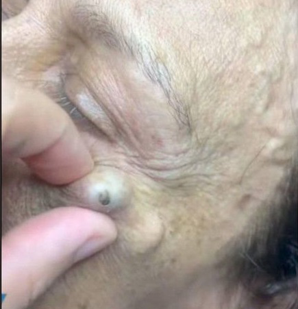 Blackheads Pimple Popper on Face 240