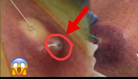 Blackheads Pimple Popper on Face 127