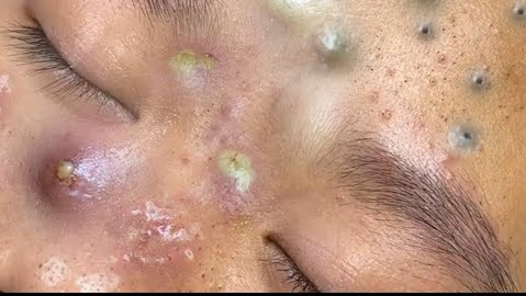 Blackheads Pimple Popper on Face 142