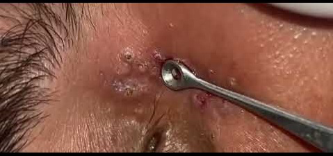 Blackheads Pimple Popper on Face 143