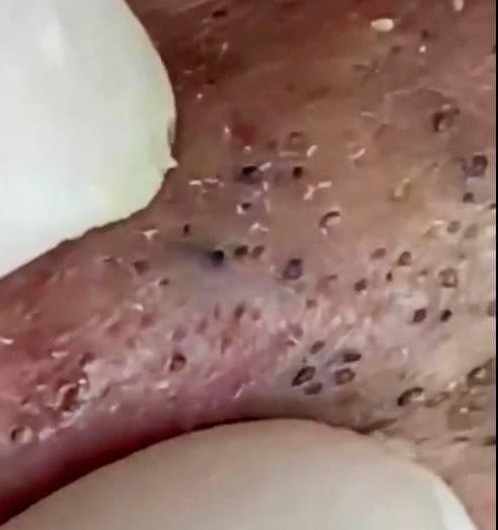 Blackheads Pimple Popper on Face 243