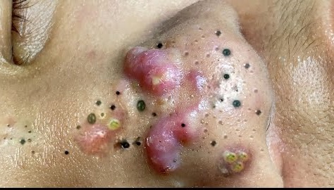 Blackheads Pimple Popper on Face 114