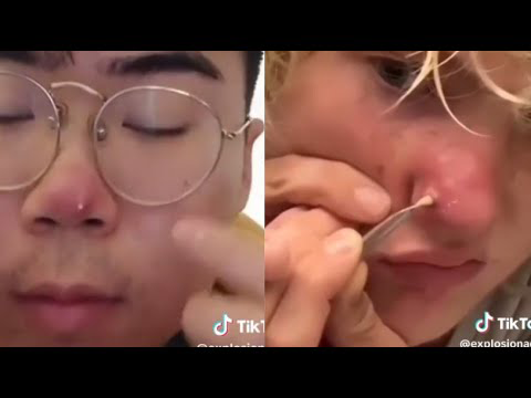 Blackheads Pimple Popper on Face 129