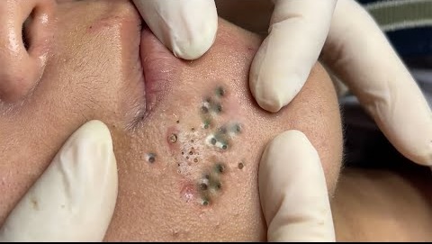 Blackheads Pimple Popper on Face 117