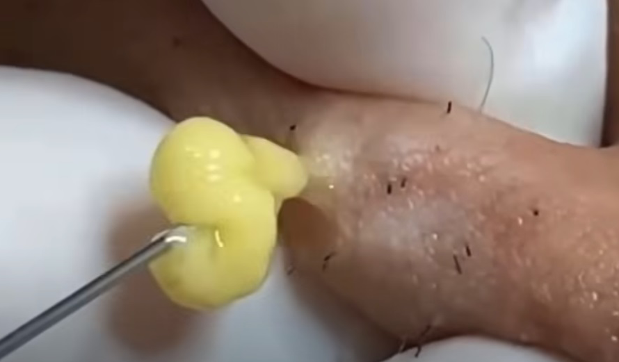 Blackheads Pimple Popper on Face 222