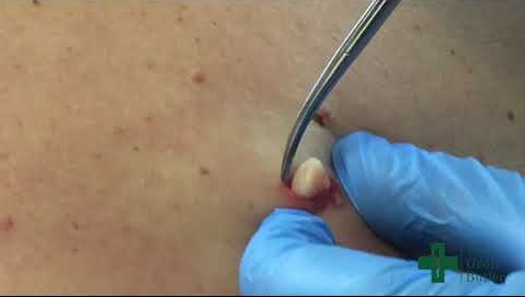 Blackheads Pimple Popper on Face 116