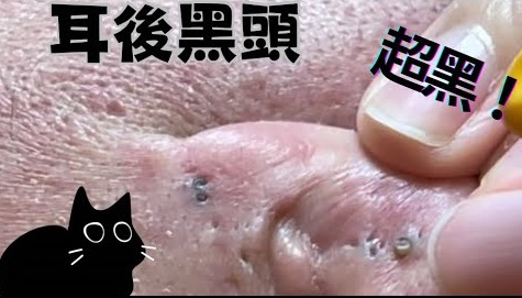 Blackheads Pimple Popper on Face 146