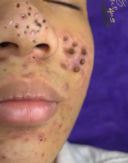 Blackheads Pimple Popper on Face 227