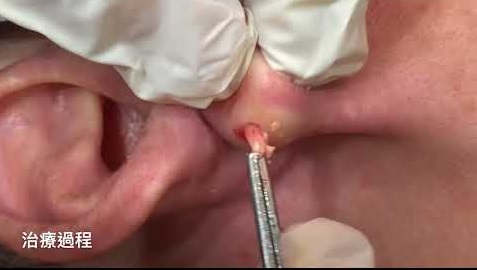 Blackheads Pimple Popper on Face 147