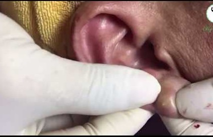 Blackheads Pimple Popper on Face 230