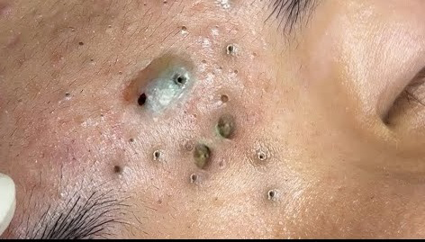 Blackheads Pimple Popper on Face 231