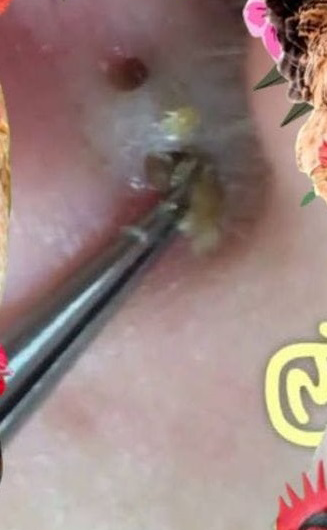 Blackheads Pimple Popper on Face 191