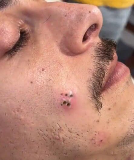 Blackheads Pimple Popper on Face 212