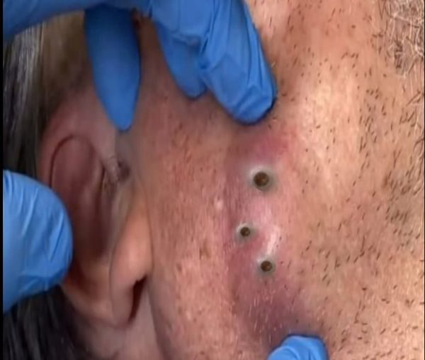 Blackheads Pimple Popper on Face 235