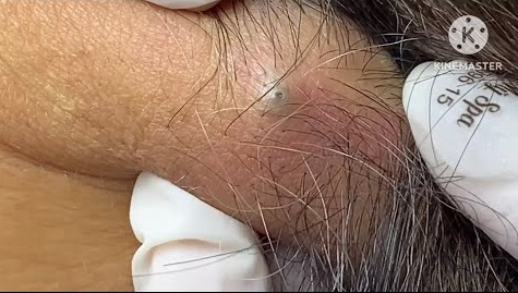 Blackheads Pimple Popper on Face 121