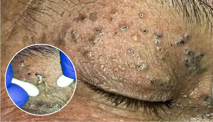 Blackheads Pimple Popper on Face 236