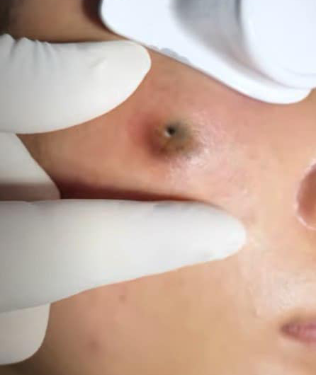 Blackheads Pimple Popper on Face 122