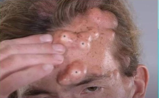 Blackheads Pimple Popper on Face 237