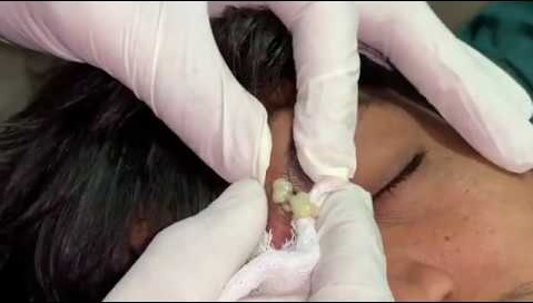 Blackheads Pimple Popper on Face 139