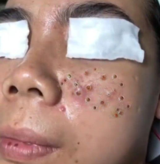 Blackheads Pimple Popper on Face 238