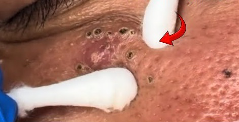 Blackheads Pimple Popper on Face 239