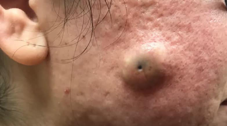 Blackheads Pimple Popper on Face 125