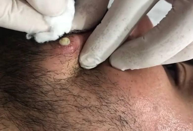 Blackheads Pimple Popper on Face 273