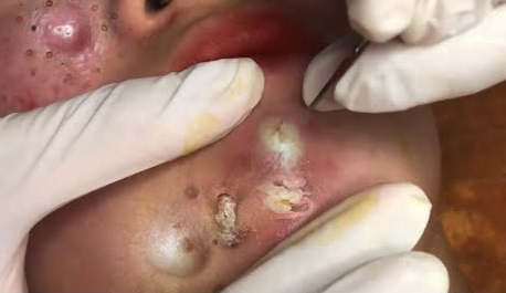 Blackheads Pimple Popper on Face 282