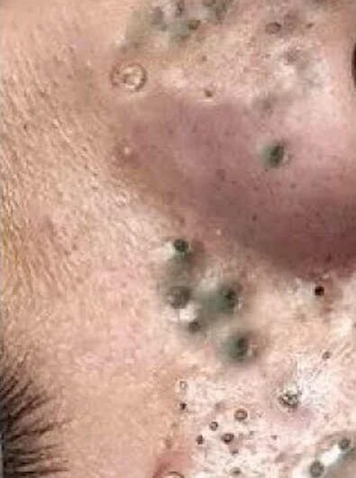 Blackheads Pimple Popper on Face 282