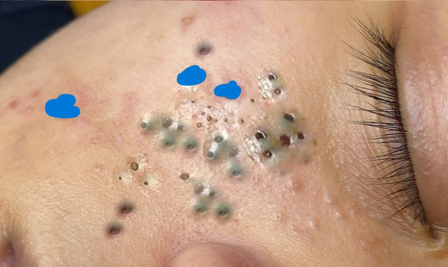 Blackheads Pimple Popper on Face 259